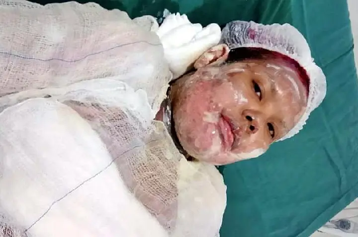 Mulher de 31 anos morre após queimaduras em Vilhena e caso levanta suspeitas