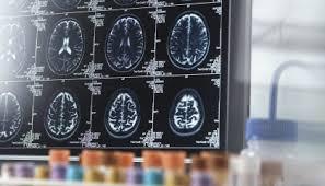 Cientistas descobrem como “ouvir” sintomas de Alzheimer; entenda