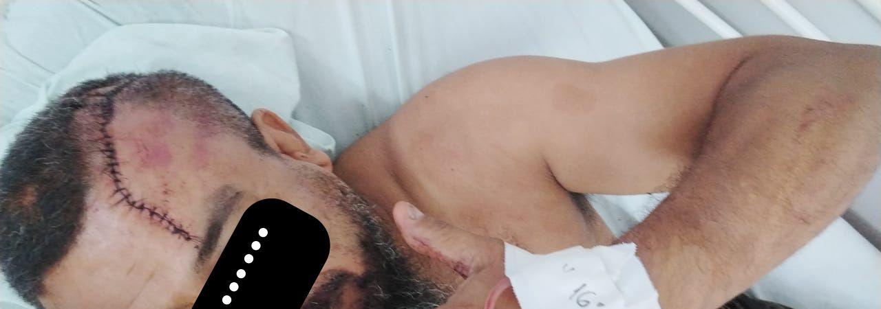 POLICIAL CIVIL QUE CAPOTOU COM VIATURA DA DEP DE LÁBREA AINDA SE RECUPERA DO ACIDENTE QUASE FATAL AO LONGO DA BR-230