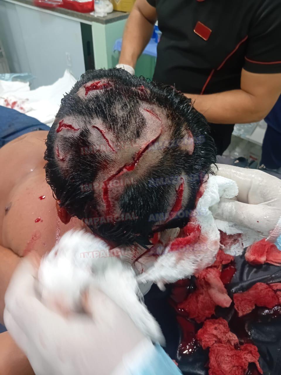 CACIQUE APURINÃ CONTINUA INTERNADO NO HOSPITAL DE LÁBREA DEPOIS DE QUASE DEVORADO POR ONÇA PINTADA