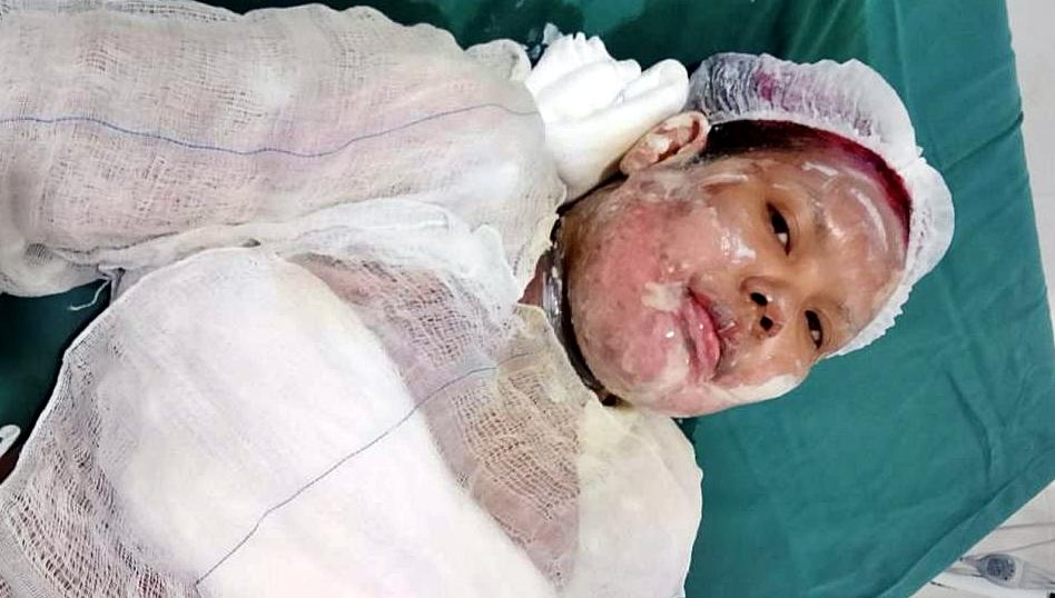 Mulher de 31 anos morre após queimaduras em Vilhena e caso levanta suspeitas